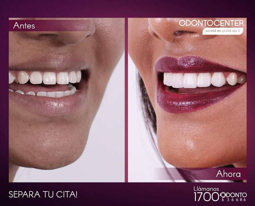 Diseño de Sonrisa | Carillas