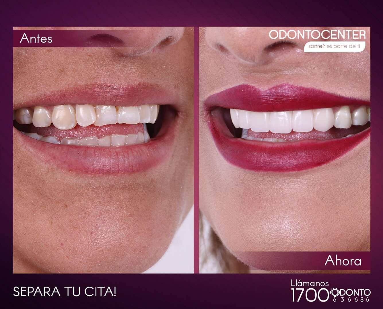 Diseño de Sonrisa