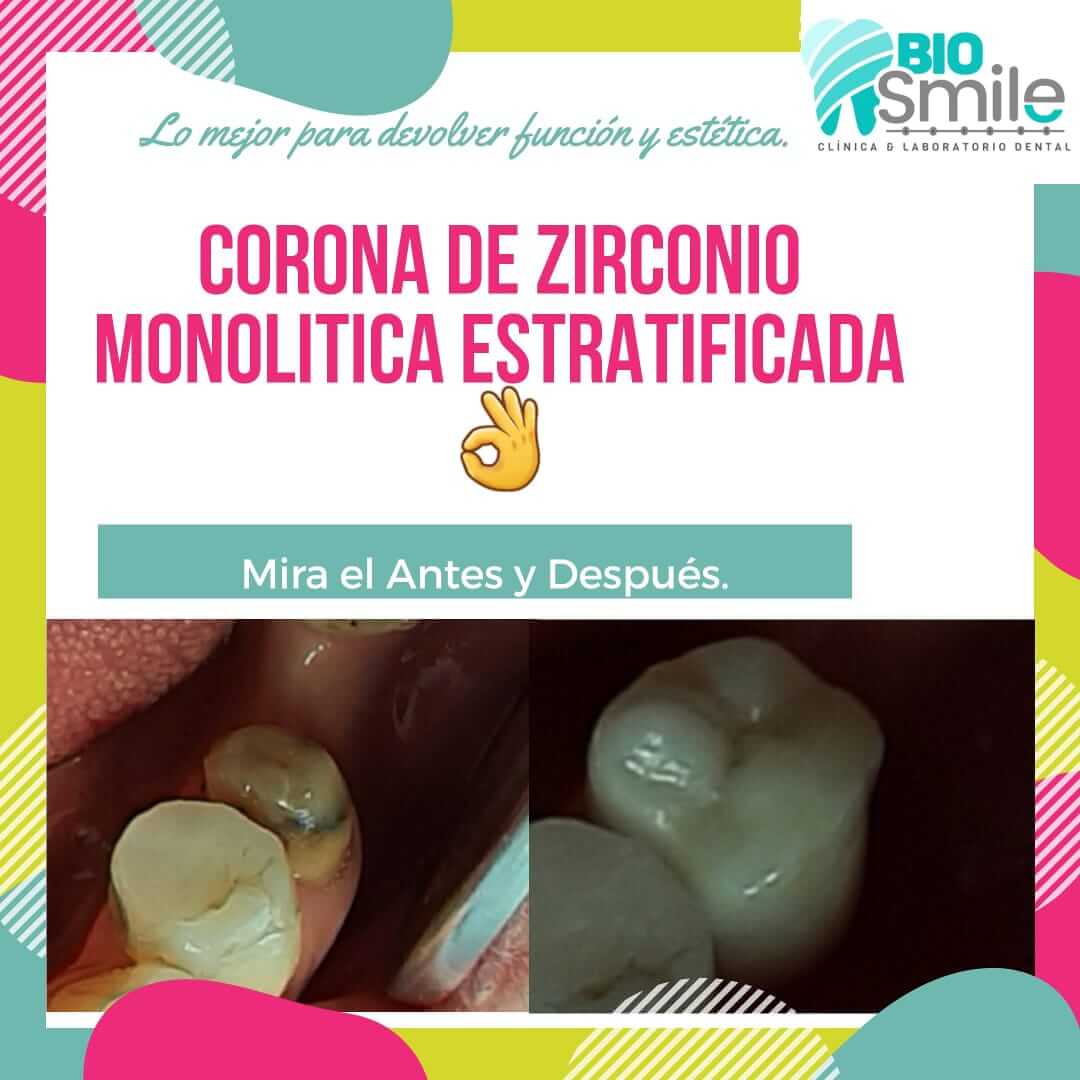 Corona de Zirconio Monolitica Estratificada