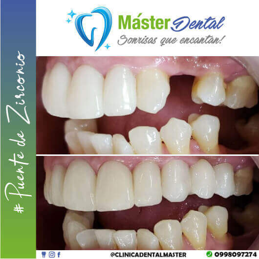 PUENTE DE ZIRCONIO | MÁSTER DENTAL TÚ MEJOR SONRISA 😁