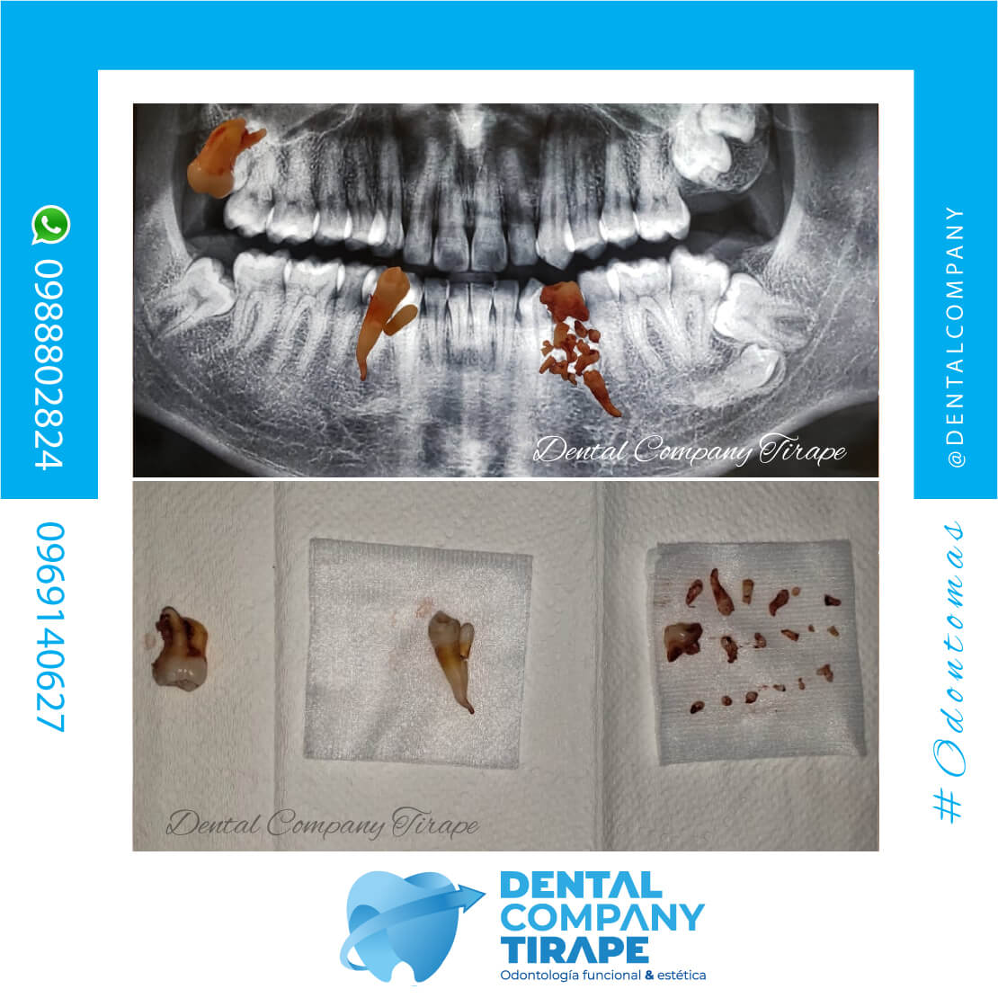 👉 Cirugias multiples : tercer molar , super numerario y odontomas