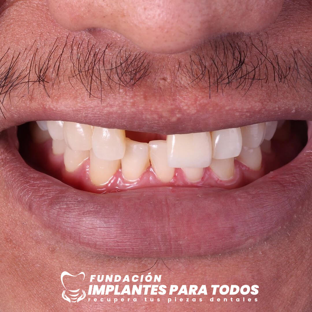 Recupera tu Pieza Dental ✅ con Implantes Dentales de Titanio 