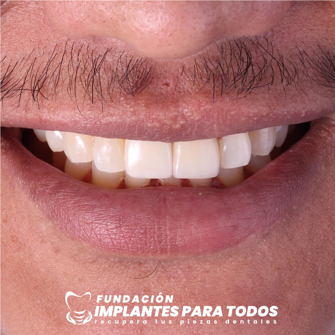 Recupera tu Pieza Dental ✅ con Implantes Dentales de Titanio 