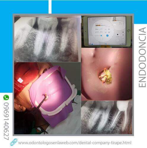 ENDODONCIA en manos de profesionales