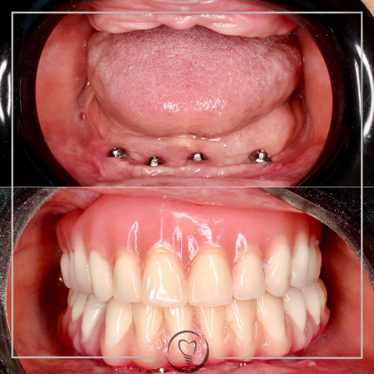 TE FALTA UN DIENTE? 🙊OBTÉN UNA SONRISA SEGURA CON IMPLANTES DENTALES