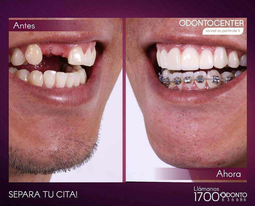 Implantes Dentales