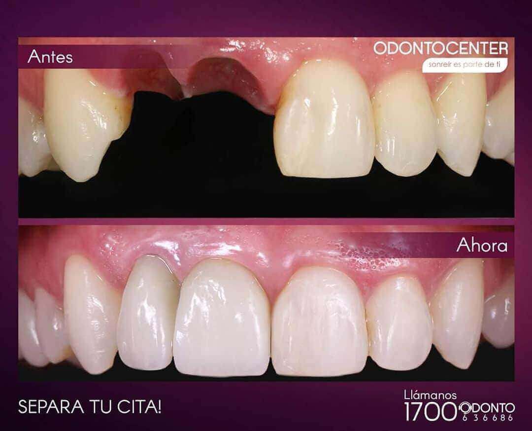 Implantes Dentales