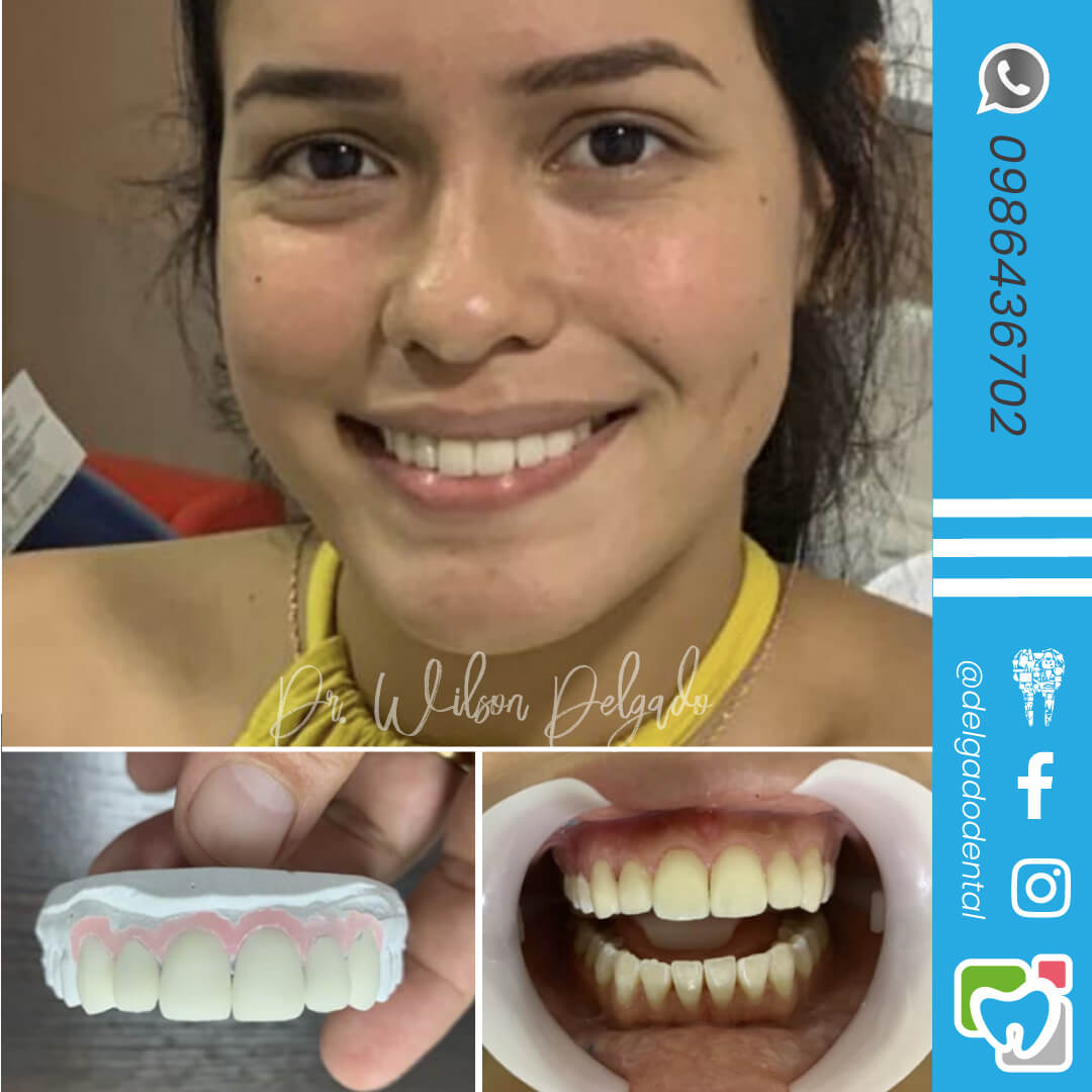 Carillas Dentales - Estética Dental - Instituto Maxilofacial