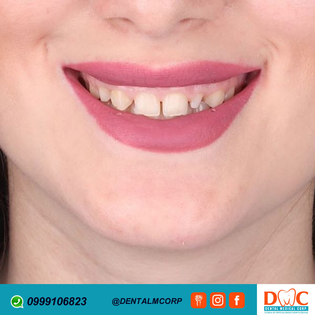 Carillas de cambio de imagen de sonrisa con Dental Medical Corp