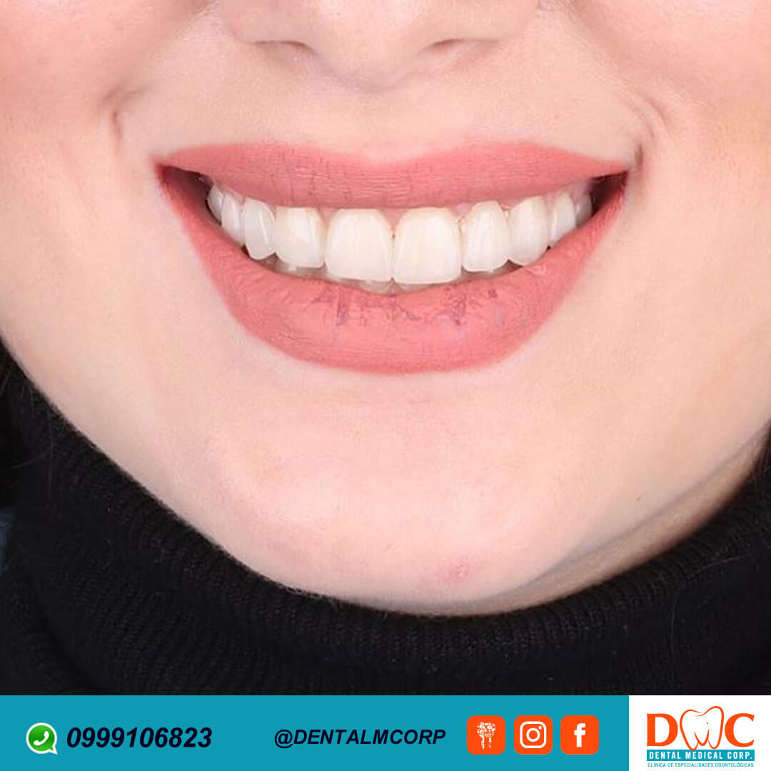 Carillas de cambio de imagen de sonrisa con Dental Medical Corp