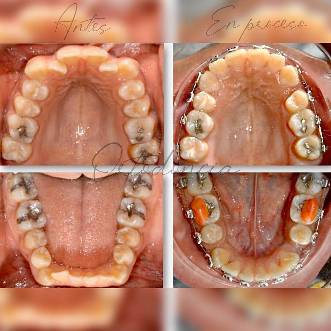 Ortodoncia 😁Caso en proceso, lleva 4 meses de tratamiento 