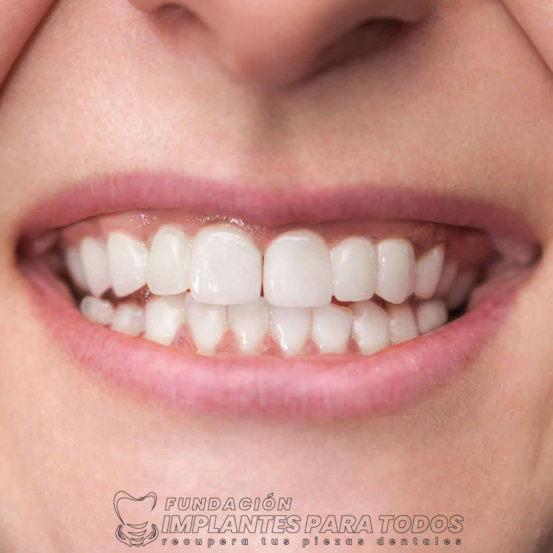 IMPLANTES DENTALES + CARILLAS DE ZIRCONIO