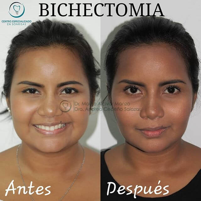 BICHECTOMÍA🙆‍♀️ . Llegó la hora de afinar tu rostro.!.