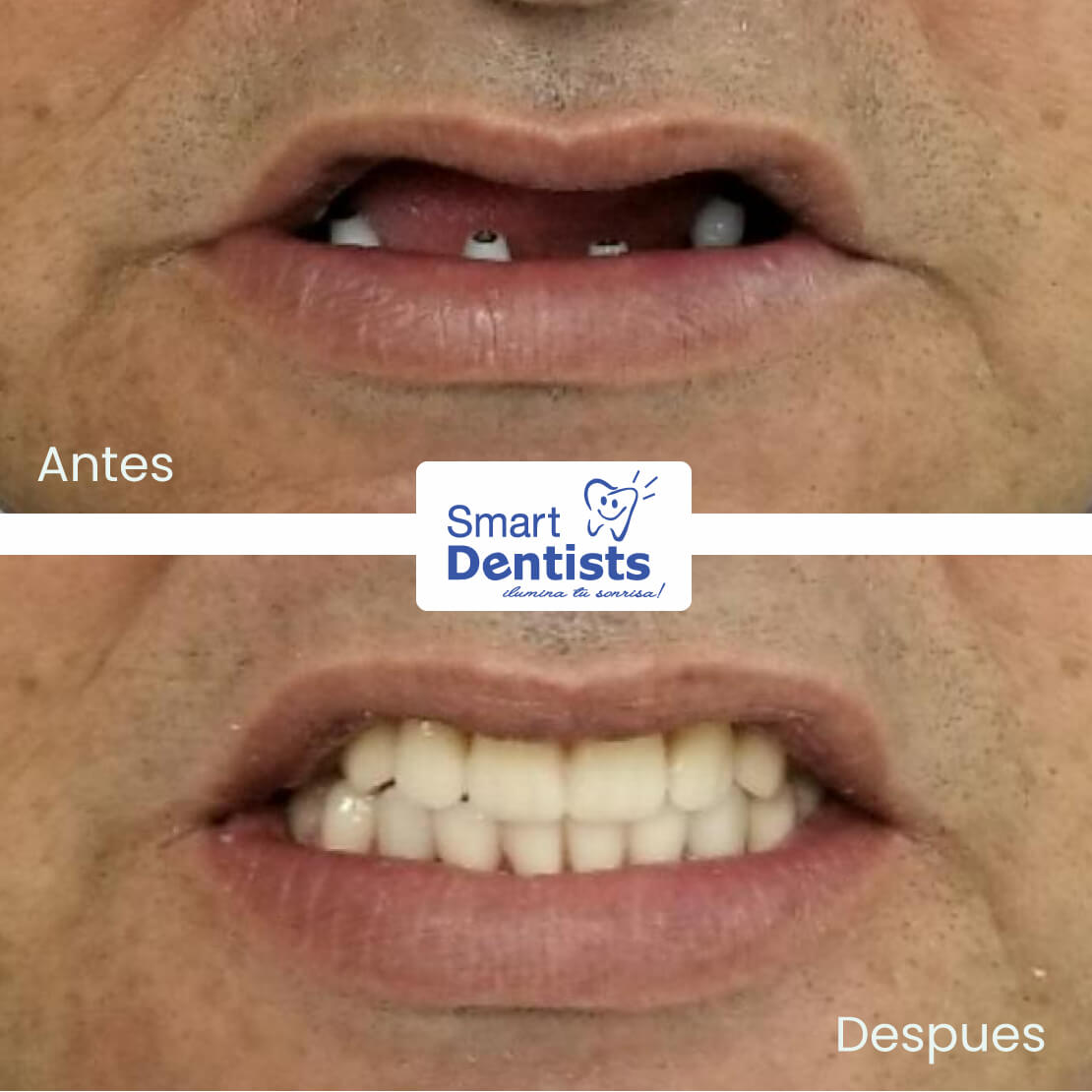 Jamás dejes de sonreir 😁 Implantes dentales con el Dr. David Flor