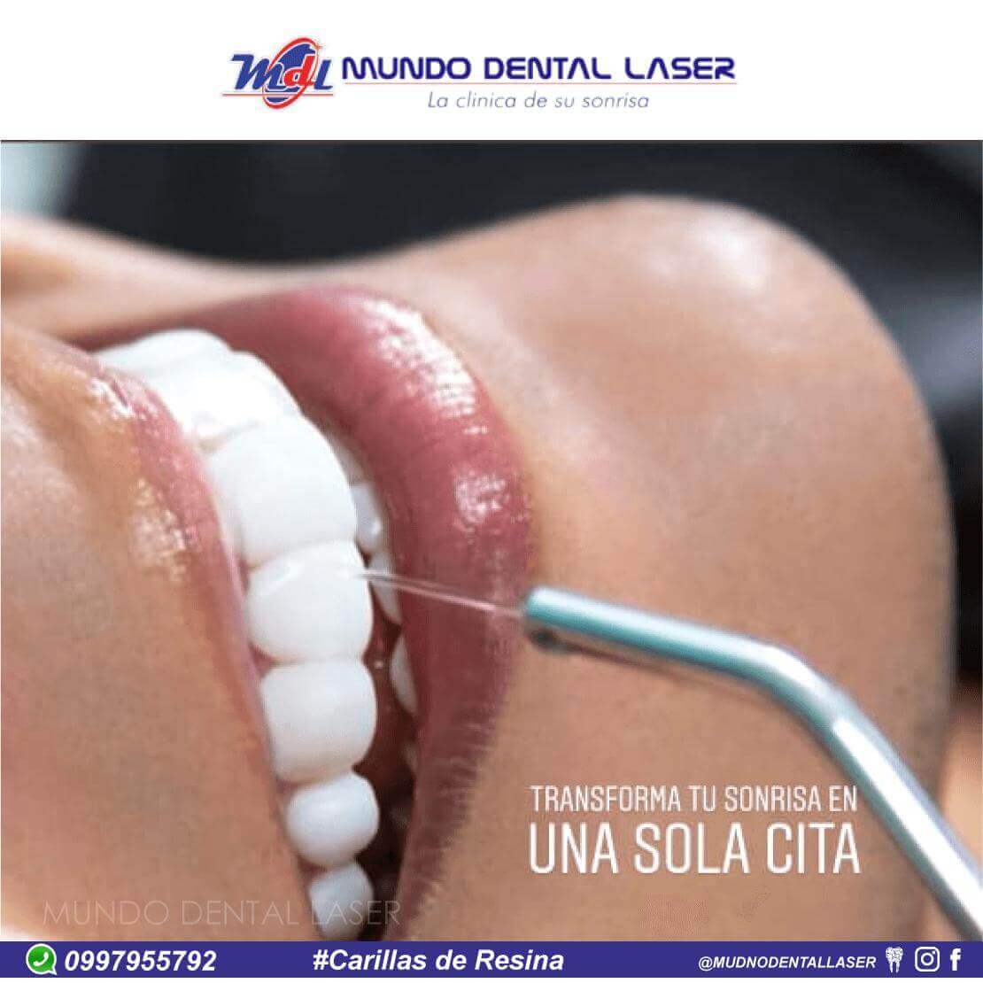 👉🏼Carillas de Resina en Alta Estética 😁 Mundo Dental Laser