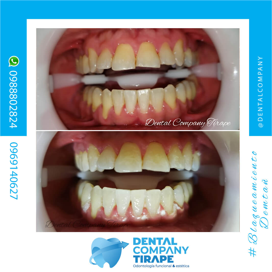 🤩En Dental Company queremos ver tu sonrisa brillar por eso te ofrecemos Blanqueamiento Dental