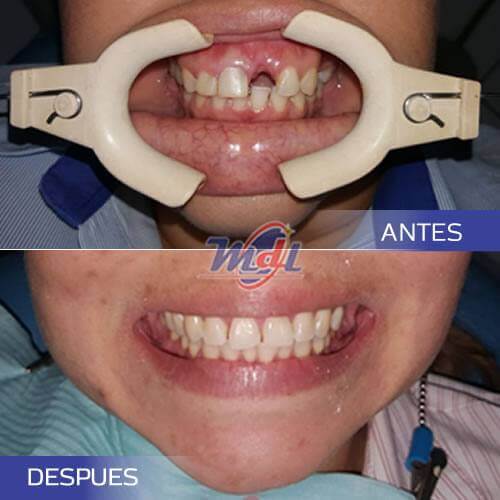 👉🏼 Obten una Sonrisa segura con IMPLANTES DENTALES 😁