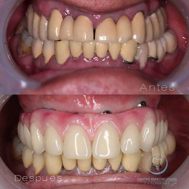 Caso de All ON SIX terminada, Protesis atornillada sobre Implantes dentales.