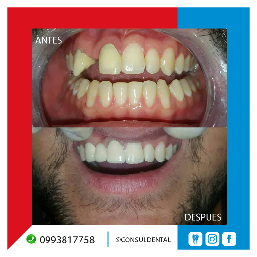 ✔️OBTEN UNA NUEVA SONRISA CON CONSUL DENTAL 😁