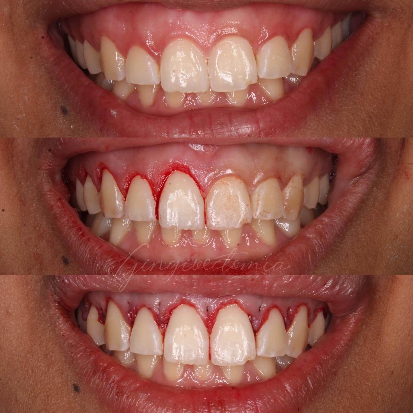 Gingivectomía estética: solución rápida, sencilla y eficaz para la sonrisa gingival.