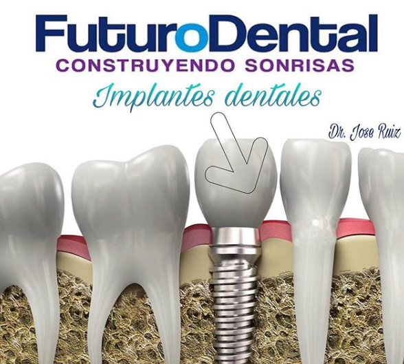 Implantes Dentales