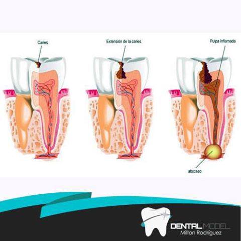 GINGIVITIS 