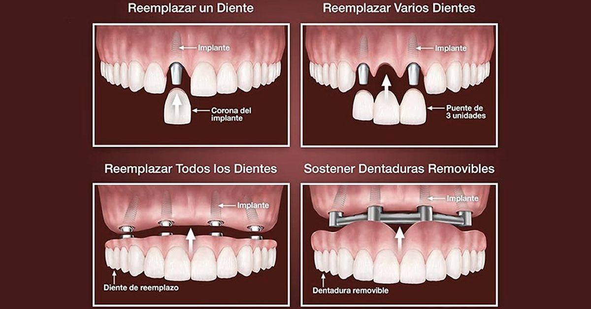 ¿Ya conoce los tipos de implantes y los beneficios que tienen?