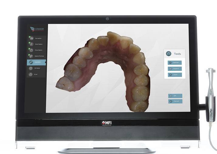 Escáner intraorales 3D