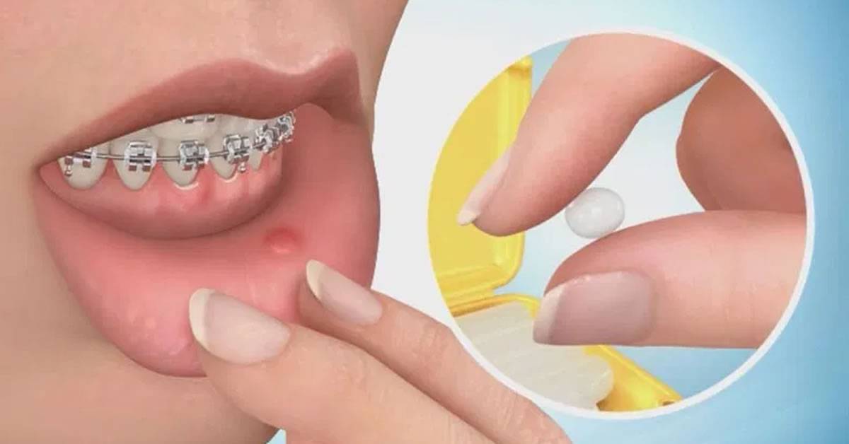 Cómo usar la cera dental para ortodoncia ✅