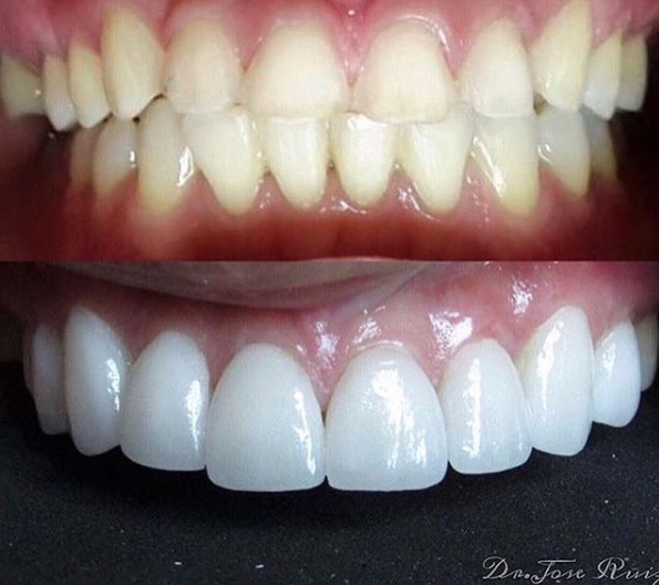 Carillas Dentales de Porcelana  Tratamiento, Recuperación y Costo