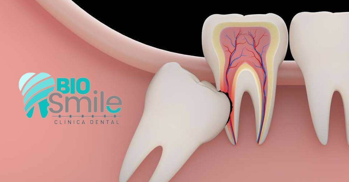 Todo sobre las cordales ▷ BIOSMILE ◁