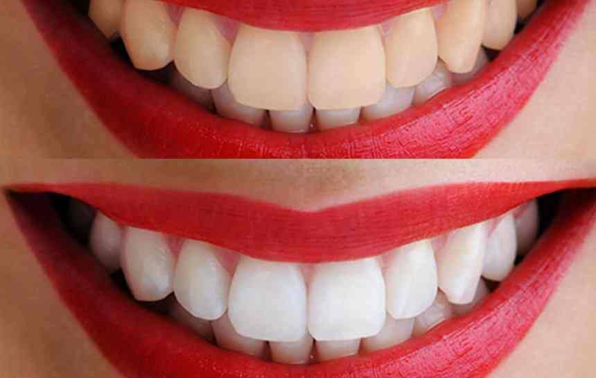 Preguntas frecuentes sobre el blanqueamiento dental