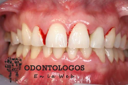 ¿Qué es la gingivitis?