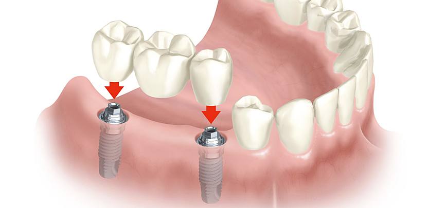 ¿Es Importante un Implante Dental?