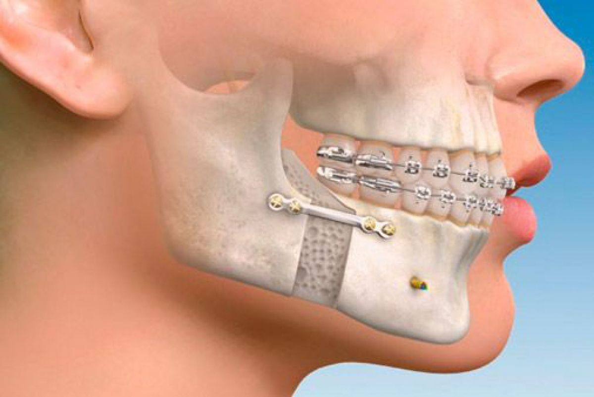 ¿Cuando es necesaria la cirugía maxilofacial?