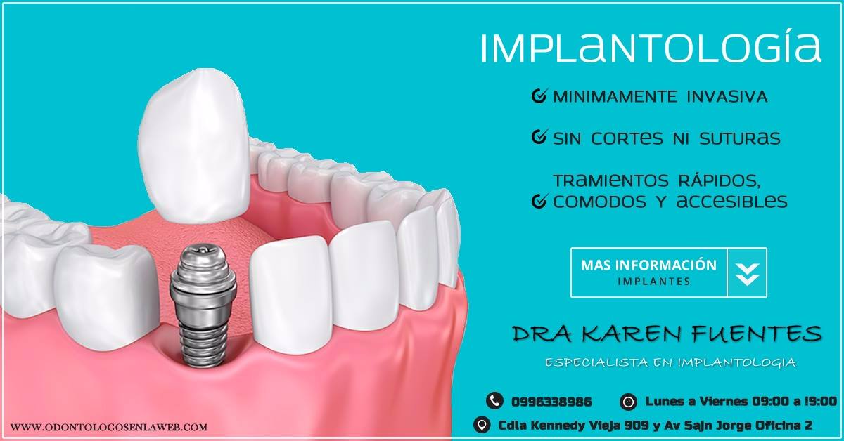 IMPLANTES DENTALES 