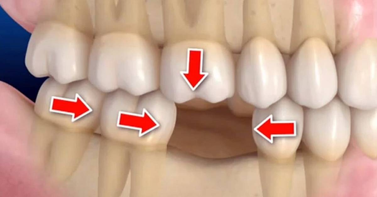 ¿QUÉ CONSECUENCIAS TIENE LA FALTA DE DIENTES?