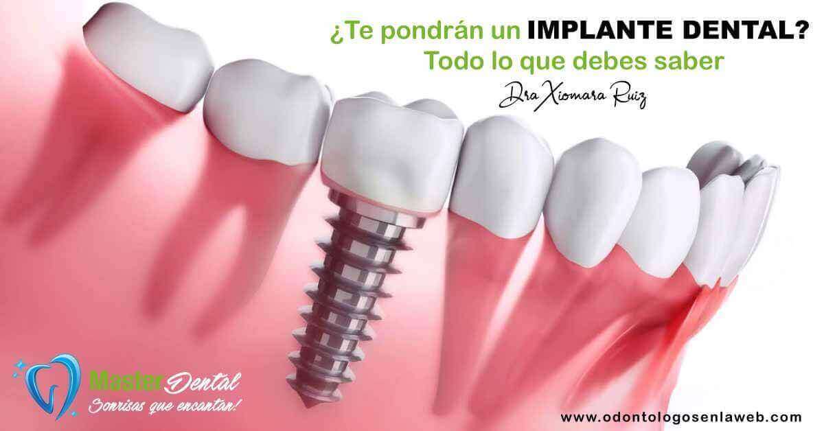 ¿Te pondrán un implante dental? Todo lo que debes saber