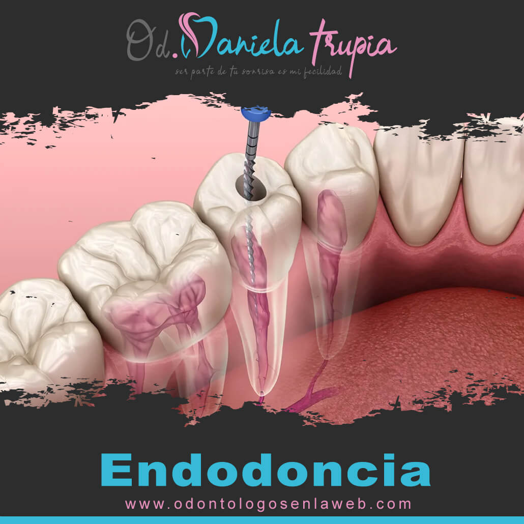 Tratamiento de Endodoncia