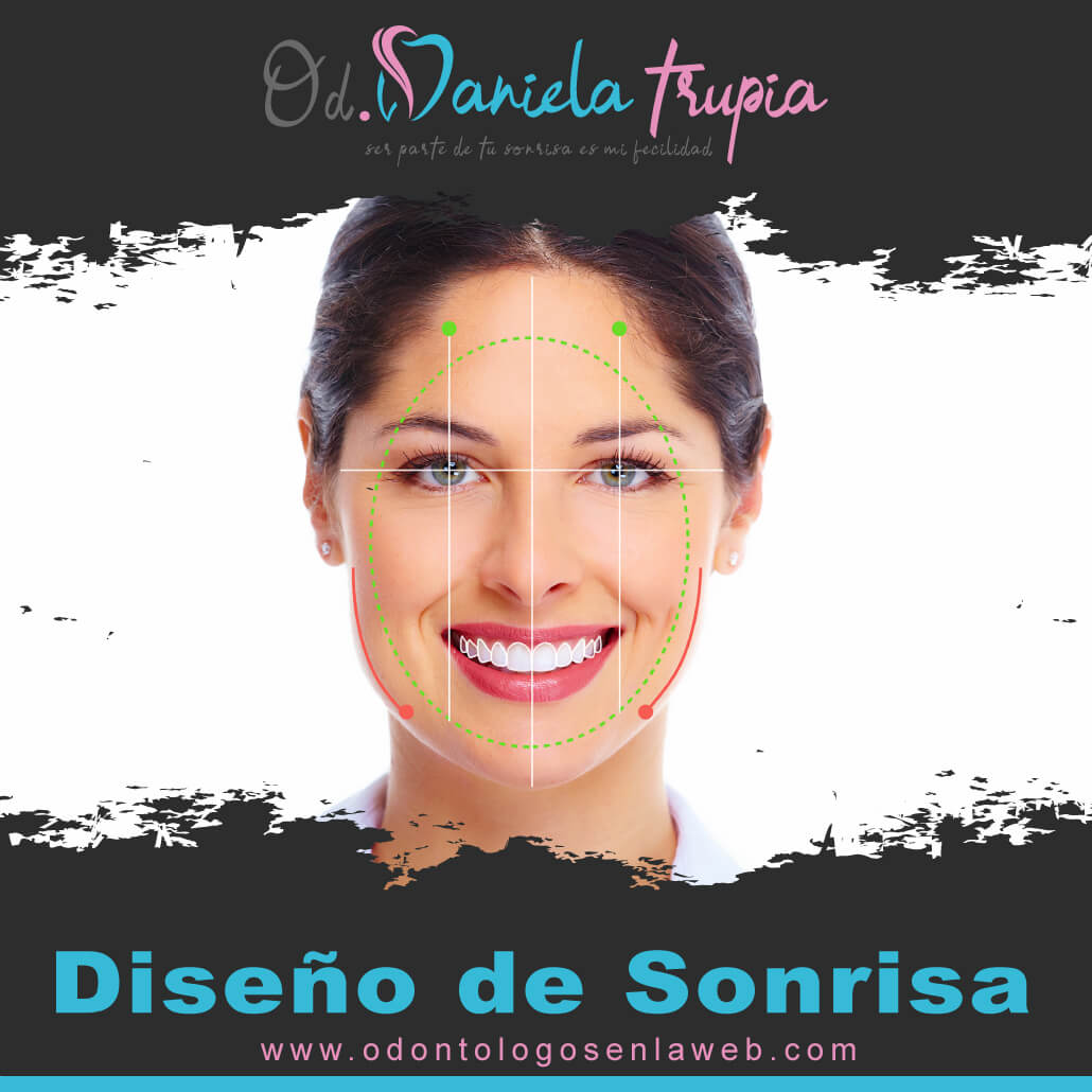 Tratamiento de Diseño de Sonrisa (Carillas Esteticas)