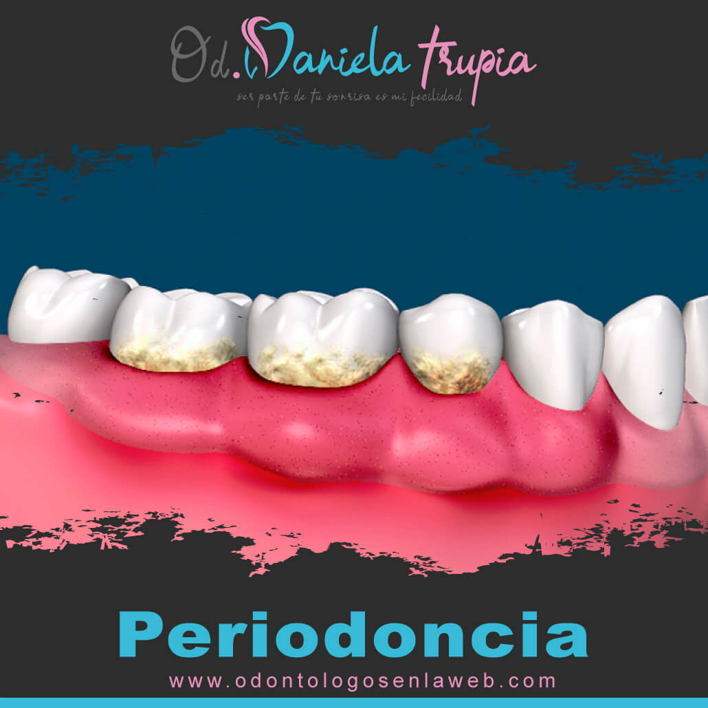 Tratamiento de Periodoncia