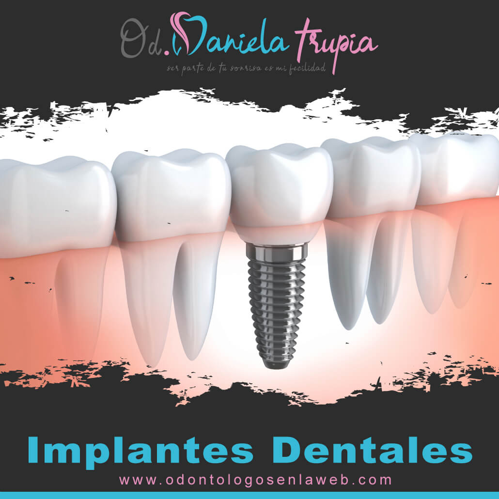 Tratamiento de Implantes Dentales