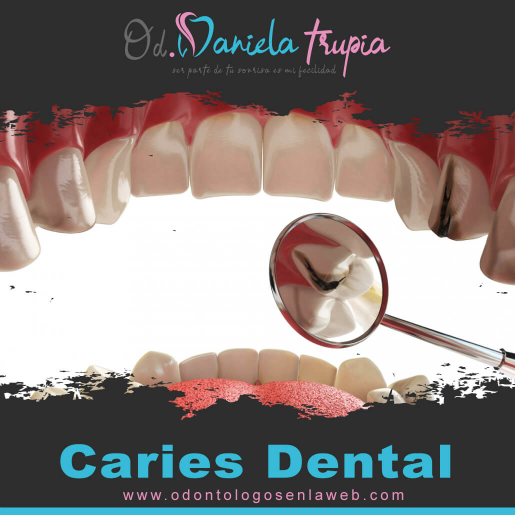 Tratamiento de Restauración Caries Dental