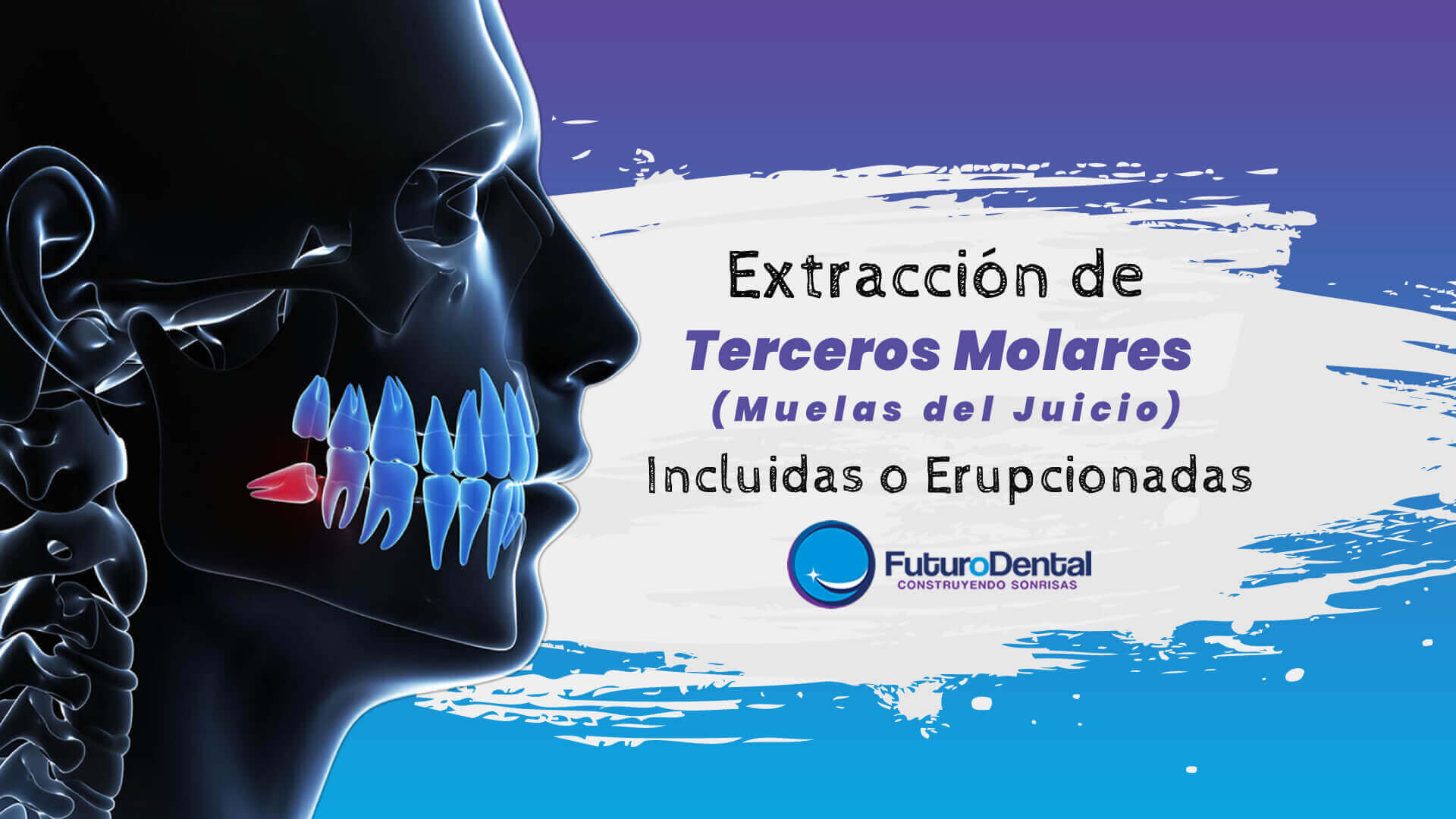 Extracción de Terceros Molares 𝑺𝒊𝒏 𝑫𝒐𝒍𝒐𝒓 (Incluidos o Erupcionados) en manos de especialistas 👨 