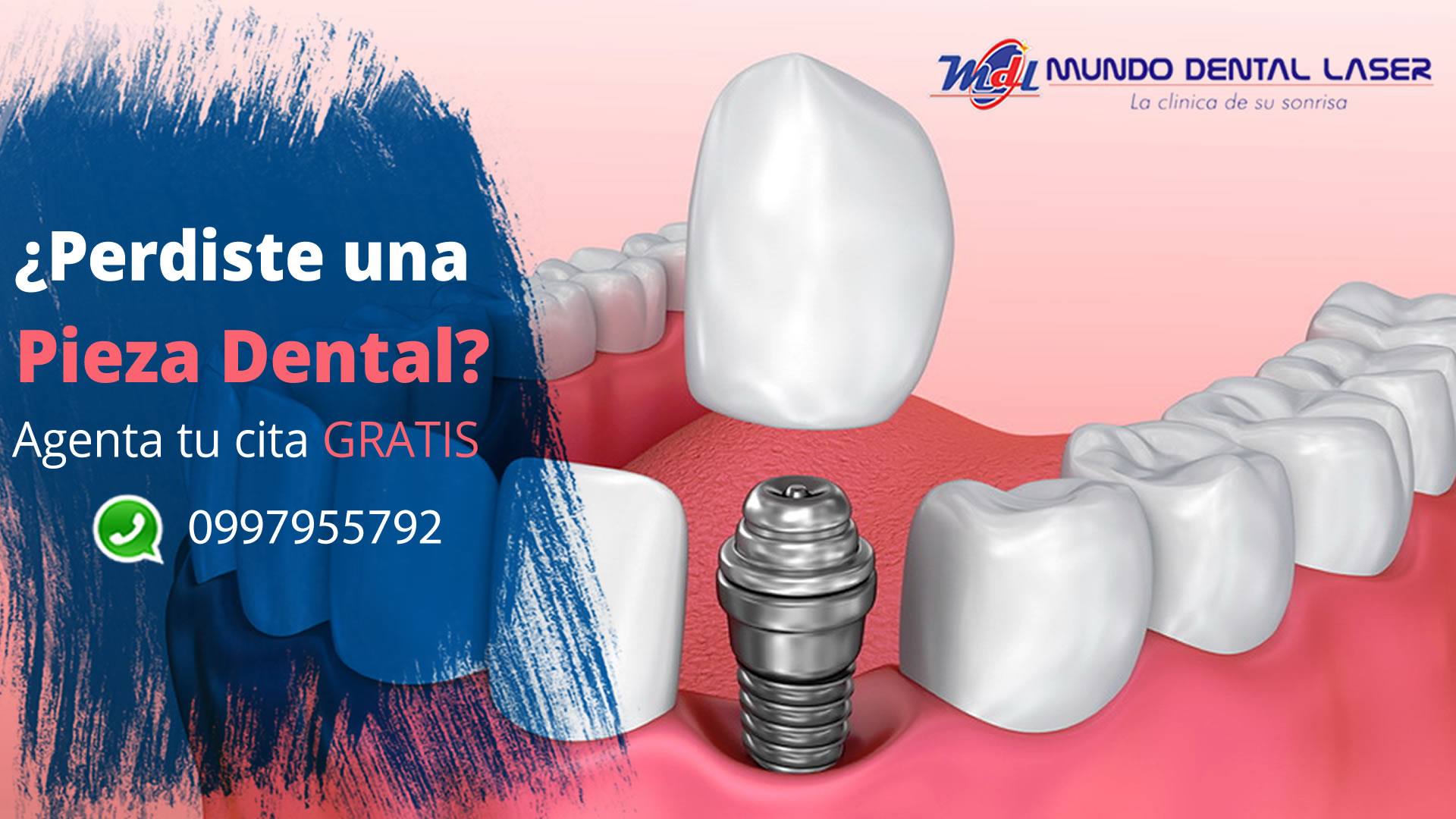 OBTEN UNA SONRISA SEGURA CON IMPLANTES DENTALES 😁