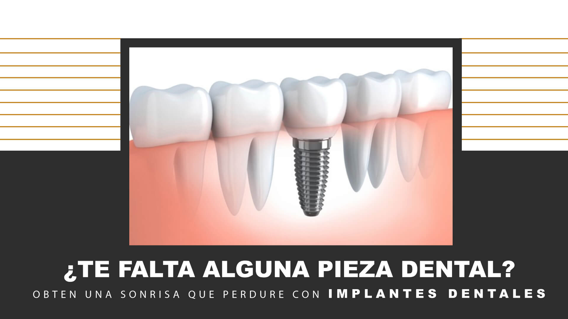 Obten una Sonrisa que perdure con IMPLANTES DENTALES 