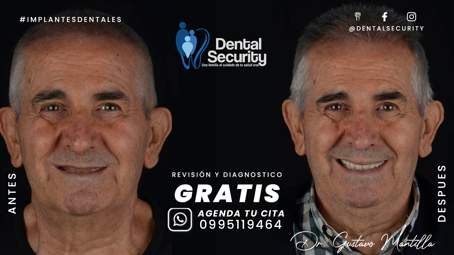 IMPLANTES DENTALES A UN PRECIO QUE TE SORPRENDERA😱