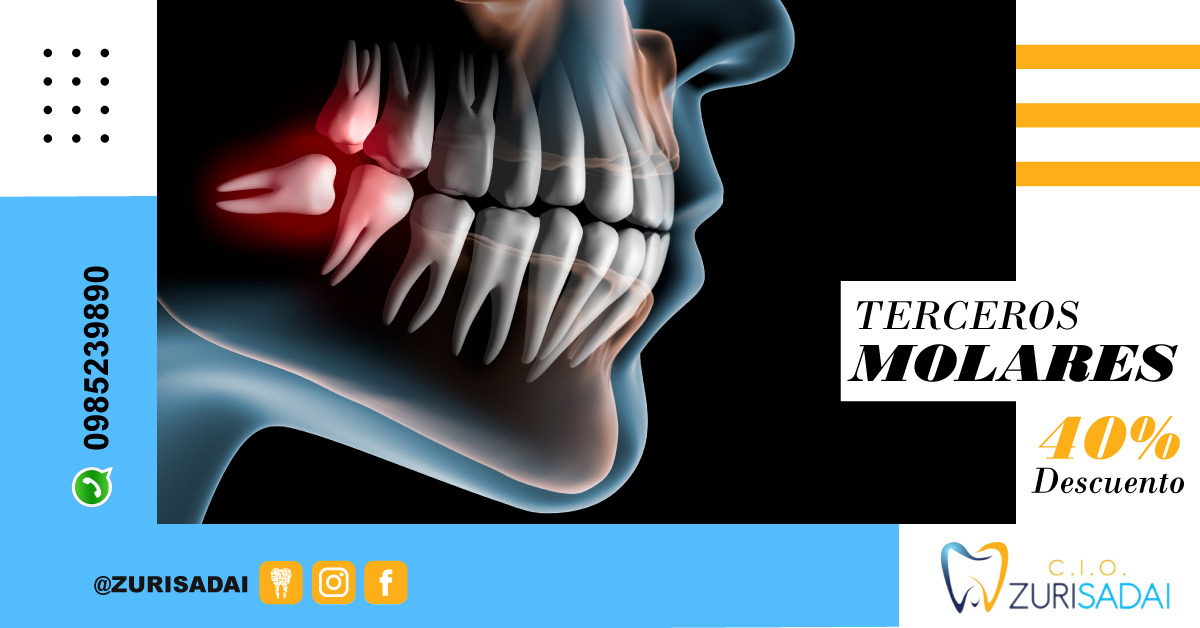 No pierdas esta oportunidad ✅  Promoción Extracción de Terceros Molares (Incluidas o Erupcionadas) con 40% de Descuento