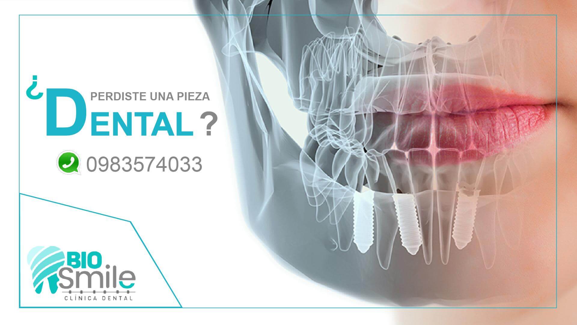 Perdiste uno o algunos de tus dientes y ahora no sabes que hacer?